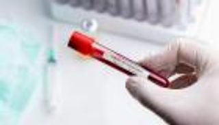 أول إصابة بفيروس كورونا في ليسوتو الأفريقية 