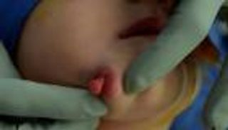 حالة طبية نادرة.. طفلة تولد بفمين كاملين 