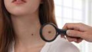 متى تمثل الشامة خطرا على الجلد؟