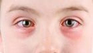 مرض التراخوما.. الأسباب والأعراض وطرق الوقاية والعلاج