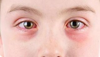 مرض التراخوما يصيب الأطفال بشكل أكبر من الكبار