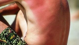 أي التهاب يصيب البشرة بسبب أشعة الشمس يزيد خطر الإصابة بسرطان الجلد