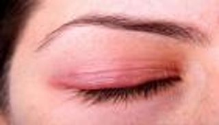 التهاب الجفون.. الأسباب والأعراض وطرق الوقاية والعلاج