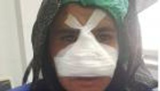 غادرت المنزل دون إذن زوجها فقطع أنفها.. مأساة أفغانية