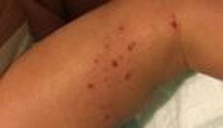 الإكزيما.. اختبار يكشف مخاطر "التهاب الجلد التأتبي"