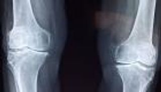 طريقة مبتكرة لإعادة نمو الغضروف في المفاصل