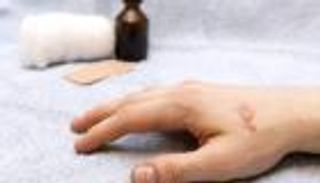 طرق منزلية لعلاج الحروق