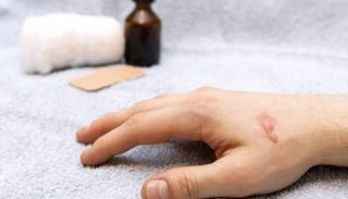 طرق منزلية لعلاج الحروق