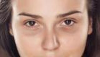 الهالات السوداء.. عادات سيئة تطفئ إشراقتك