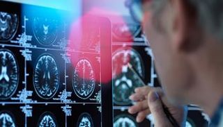 تأثير "كوفيد-19" على الدماغ يثير ذهول العلماء