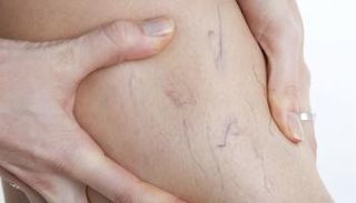 ينبغي علاج دوالي الساقين في أسرع وقت ممكن لتجنب المضاعفات