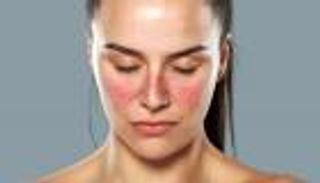 مرض الذئبة الحمراء.. أسبابه وأعرضه وطرق العلاج