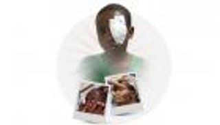 إنفوجراف.. مرض "التراخوما" المسبب للعمى