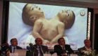 لأول مرة بالأردن.. فصل توأم سيامي يمني في عملية "نادرة"