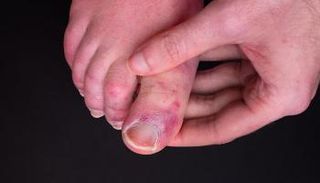 التهابات أصابع الكوفيد