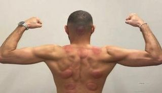 علاج كريم بنزيما بالحجامة