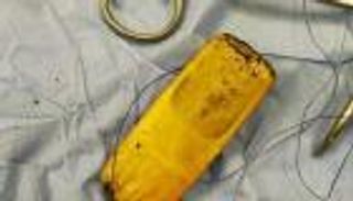 استخراج هاتف محمول من معدة مصري.. ابتلعه قبل 6 أشهر (صور)