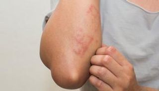 الطفح الجلدي من أعراض الساركويد 