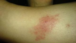 شخص مصاب بداء الليشمانيات