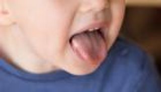 أسباب ظهور البثور على اللسان.. انتبه إلى سوء التغذية