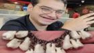 شاب مصري يهدي حبيبته أسنانه وضروسه.. صاحب الصورة يروي حقيقتها