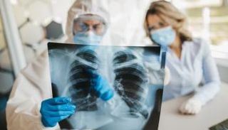 صبغة جينية مسؤولة عن خطر الإصابة بالفشل الرئوي جراء كورونا