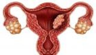 أورام الجهاز التناسلي للمرأة.. 6 علامات تحذيرية تنذر بالخطر