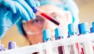 اختبار دم يحدد المعرضين لخطر الإصابة بألزهايمر