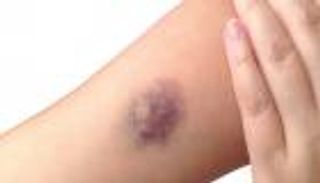 أسباب بسيطة وخطيرة لظهور بقع زرقاء على الجسم