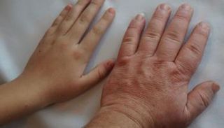 ضخامة الأطراف مرض نادر ينتج عن زيادة إفراز هرمون النمو