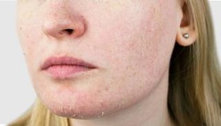 جفاف البشرة قد يحتاج أحيانا لاستشارة الطبيب