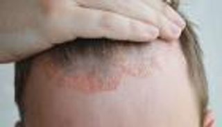 مرض الصدفية.. اكتشاف جديد على طريق العلاج