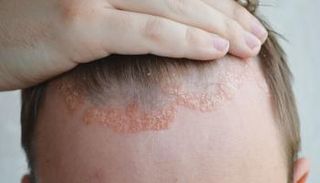 هدف علاجي جديد للصدفية 