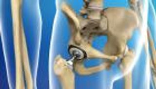 متى يمكن ممارسة الرياضة بعد جراحة مفصل الورك؟