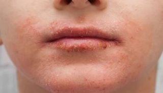 الطقس يلعب دورا كبيرا في جفاف البشرة