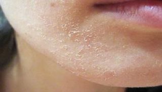 تعاني البشرة في الشتاء من الجفاف والخشونة