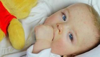 حليب البقر هو السبب الأبرز لحساسية الألبان