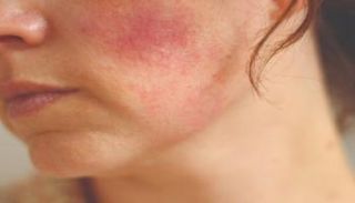 الحروق من أكثر أضرار التعرض المفرط للشمس