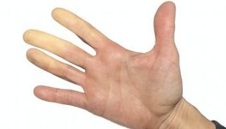 متلازمة رينود هي مرض وعائي ناتج عن اضطراب سريان الدم