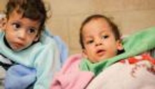 بعد عملية فصل نادرة في الأردن.. توأم يمني سيامي يعود لصنعاء