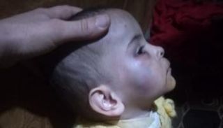 آثار الضرب على وجه إحدى الطفلتين