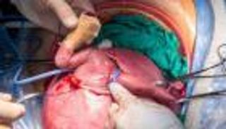 سعودي يحقق إنجازا طبيا معقدا.. إزالة ورم سرطاني من قلب جنين