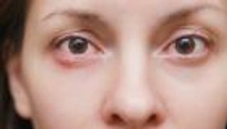 دمل الجفن.. تحذير من العلاج بالوصفات المنزلية 