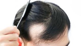 مرض الثعلبة