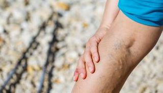 دوالي الساقين قد تؤدي إلى الإصابة بجلطة في الرئة