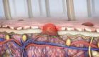 خبر سار.. فيروسات البرد الحية علاج محتمل لسرطان الجلد