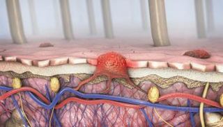 صورة تعبيرية لسرطان الجلد