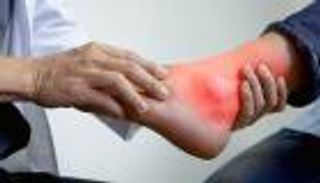 إفطار مريض النقرس في رمضان.. 3 أطعمة ممنوعة