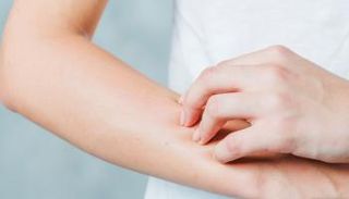 لدغة ذباب الرمل تسبب الإصابة بمرض اللشمانيا