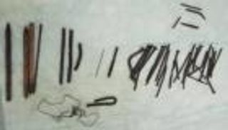 بعد 4 أشهر من ابتلاعها.. استخراج مسامير من معدة مريض إثيوبي